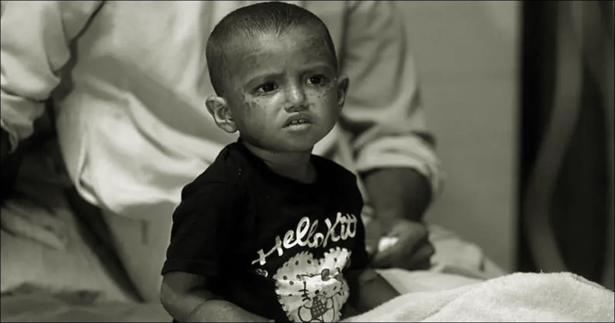 দেশে হামের প্রাদুর্ভাব আরও তীব্র: ২৪ ঘণ্টায় ১০ মৃত্যু