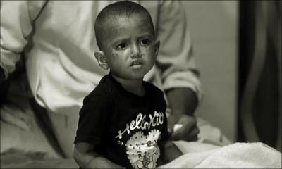 দেশে হামের প্রাদুর্ভাব আরও তীব্র: ২৪ ঘণ্টায় ১০ মৃত্যু